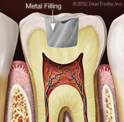 Illustration of Tooth After Metal Filling